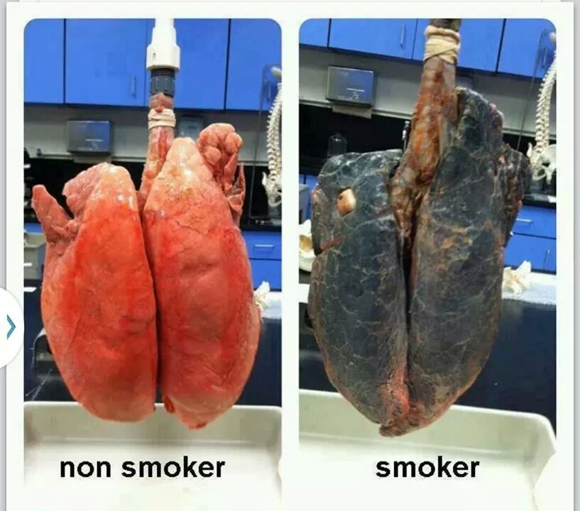 pictures of lungs after smoking weed